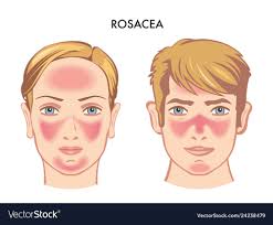 Rosacea natural treatment