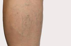 Spider veins treatment