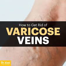 How to get rid of varicose veins